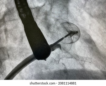X-ray image performed left atrial appendage occluder device in patient who has thrombus in left atrial appendage (LAA), Left atrial appendage closure procedures. - Shutterstock ID 2081114881