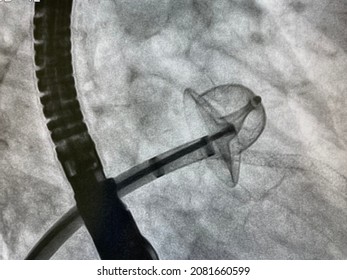 X-ray image performed left atrial appendage occluder device in patient who has thrombus in left atrial appendage (LAA), Left atrial appendage closure procedures. - Shutterstock ID 2081660599