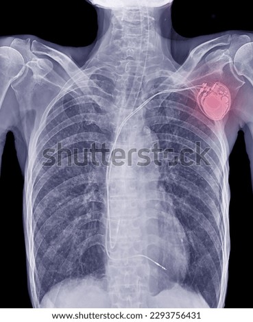 X-ray image of a permanent pacemaker in the chest and lungs, blue tones, black background.
