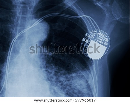 x-ray image of permanent pacemaker implant in chest body , process in blue tone