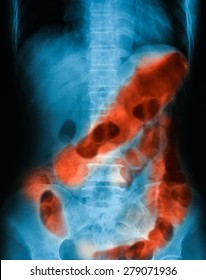 X-ray Image Of Plain Abdomen, Show Gastrointestinal Bleeding Or GI Bleeding.