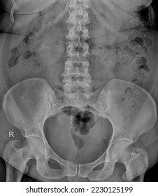 X-Ray image of plain kub (kidney, ureter,bladder ) - Shutterstock ID 2230125199