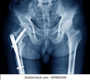X-ray image of right side human hip fracture neck of femur bone. Open Reduction Internal Fixation with internal bone rod and screw by Orthopedic surgeon