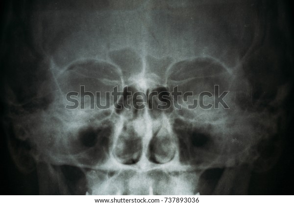 Xray Image Roentgen Human Skull Closeup Stock Photo (Edit Now) 737893036