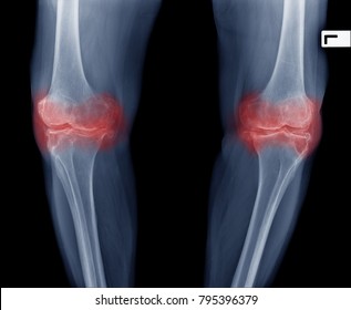 Xray Image Of Senior Woman Knee Pain Show Osteoarthritis Both Knee Joint. Knee Swelling And Inflammation.  Patient Have Serious Pain When Walking Or Standing.