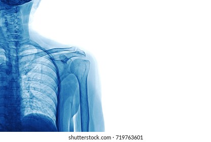 Xray Image Of Shoulder Isolated On White Background, Space For Your Message And Idea Medical Concept