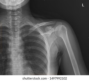 Xray Image Shoulder Ligament Shoulder Tendon Stock Photo 1497992102 ...