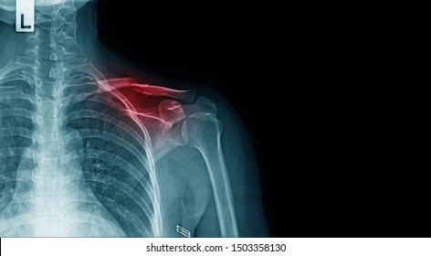 x-ray image of shoulder pain with clavicle fracture and copy space  - Shutterstock ID 1503358130