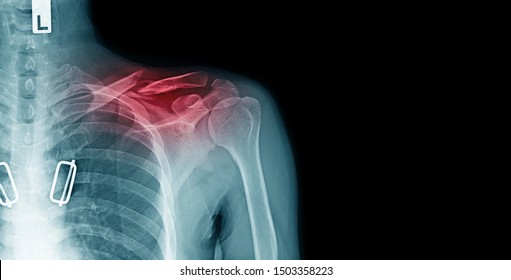 x-ray image of shoulder pain with clavicle fracture and copy space  - Shutterstock ID 1503358223