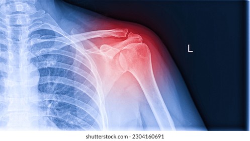 X-ray image of shoulder pain, shoulder ligament tendinitis, shoulder muscle strain