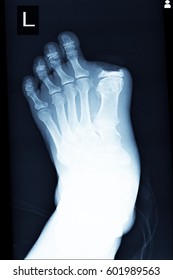 Xray Image Show Amputation At Big Toe Left Foot