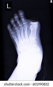 Xray Image Show Amputation At Big Toe Left Foot