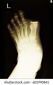 Xray Image Show Amputation At Big Toe Left Foot