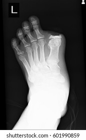 Xray Image Show Amputation At Big Toe Left Foot