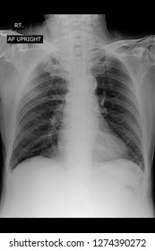 Xray Image Show Chest Xray AP Upright