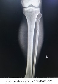 closed fracture of distal end of right fibula