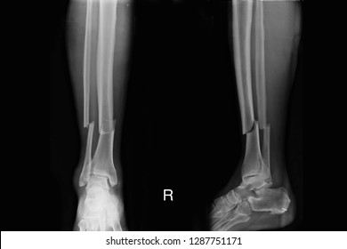 Xray Image Show Closed Fracture Right Leg