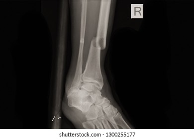 a patient underwent closed reduction of a closed fracture