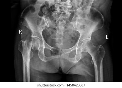 also called a closed fracture also called a closed fracture