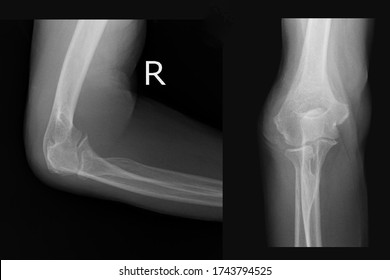 Xray Image Show Closed Fracture Right Elbow