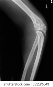 Xray Image Show Closed Fracture Left Elbow