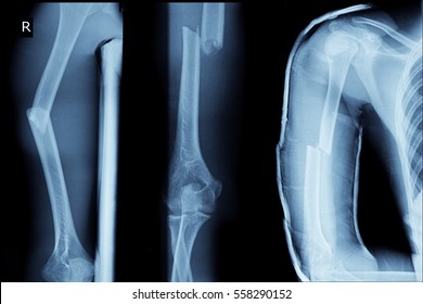 Xray Image Show Closed Fracture Right Humerus