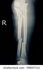 Xray Image Show Closed Fracture Elbow Right And Radius And Ulna Bone