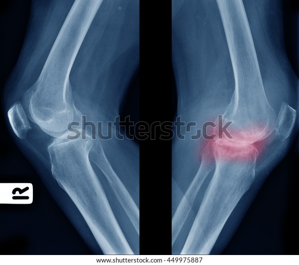 Xray Image Show Comparison Older Normal Stock Photo 449975887 ...