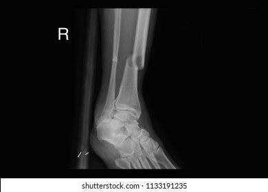 Xray image show feacture right leg