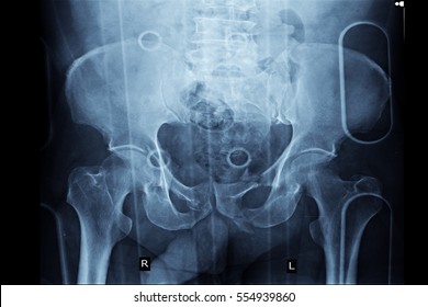 Xray Image Show Fracture Pelvic