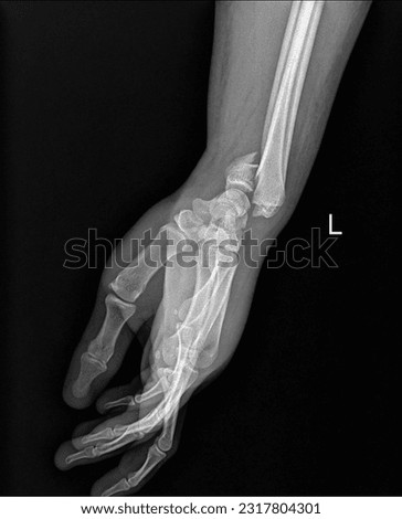 x-ray image show fracture radius ulna bone