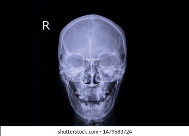 Xray Image Show Human Skull