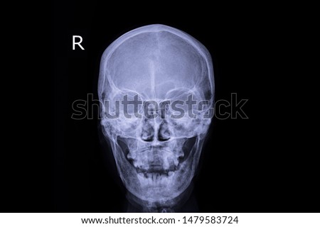 Xray image show human skull