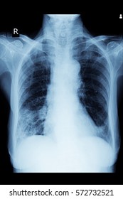 Xray Image Show Infiltration Right Lung Lower Lobe And Pneumonia