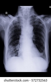 Xray Image Show Infiltration Right Lung Stock Photo 572732563 ...