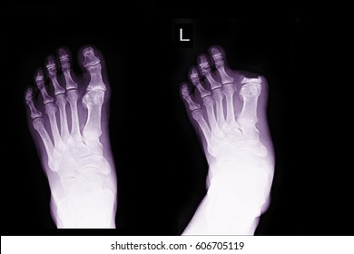 Xray Image Show Left Foot Before And After Post Operation Amputation Big Toe Left