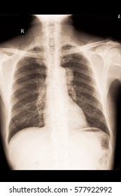 Xray Image Show Lung Cancer 