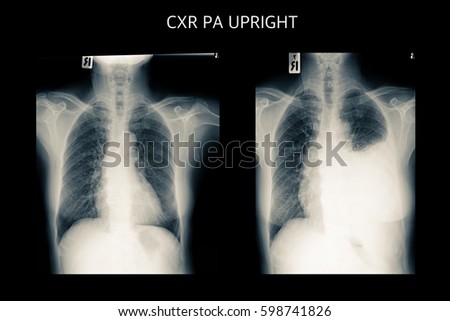 xray image show nomal chest xray and pleural effusion