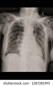 Xray Image Show Pulmonary Tuberculosis And Cardiomegaly