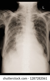 Xray Image Show Pulmonary Tuberculosis And Cardiomegaly