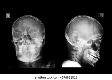 Xray Image Show Skull AP,LAT