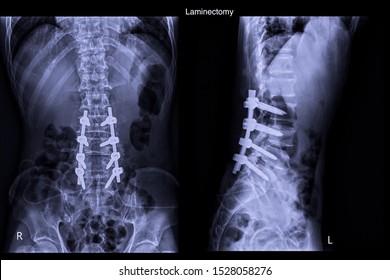 Xray Image Show Spinal Canal Stenosis And Post Operation Laminectomy