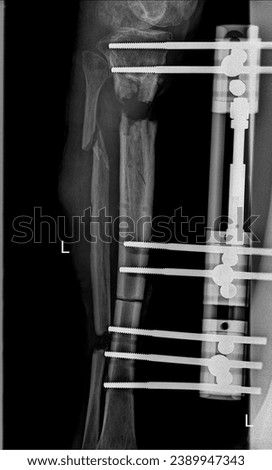  X-ray image showing external fixation of tibia and fibula fracture in the anteroposterior (AP) view.