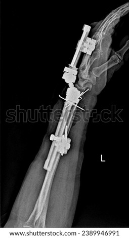  X-ray image showing fractures of the radius, ulna, and wrist joint treated with both internal and external fixation.