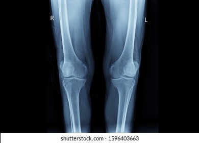 Xray image shows both knees