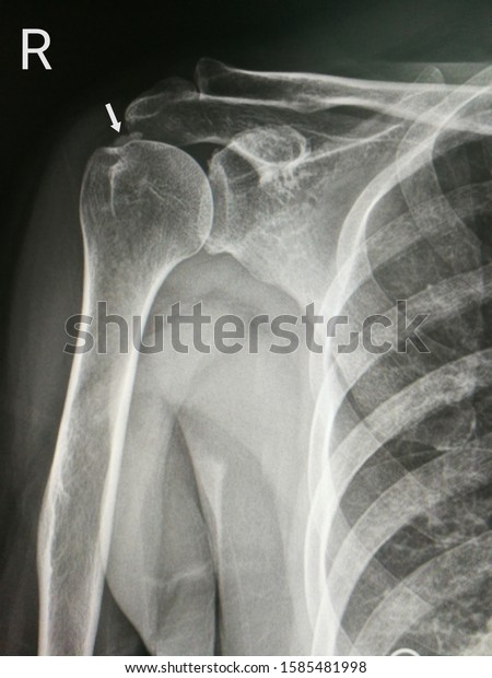 X-ray image shows right shoulder with calcified\
supraspinatus tendon.