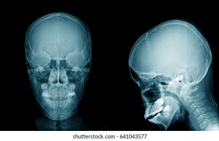 x-ray image skull frontal and lateral view  