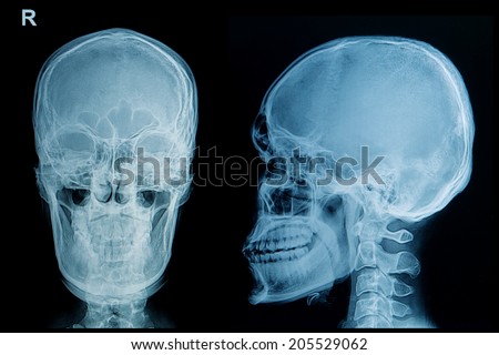 x-ray image of skull human