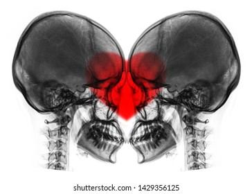 X-ray Image Of Skull Making Heart Symbols.