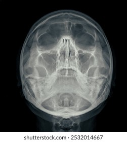X-ray image of the skull in water's view, displaying clear bone structure with no visible abnormalities.
